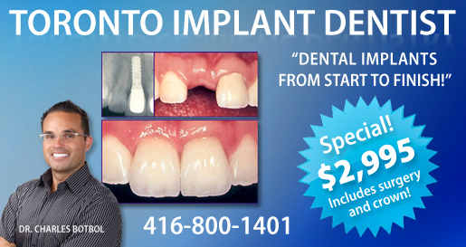 toronto dental implants