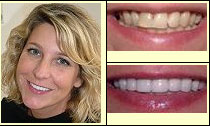 tooth whitening