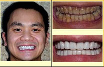 whitening zoom