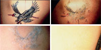 toronto tattoo removal
