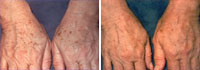 age spots and freckles treatment
