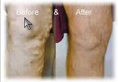 EVLT Treatment in Toronto Canada