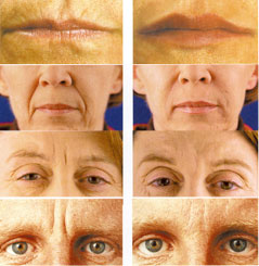 Restylane Toronto clinic