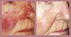 rosacea