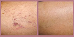 Sclerotherapy before and after